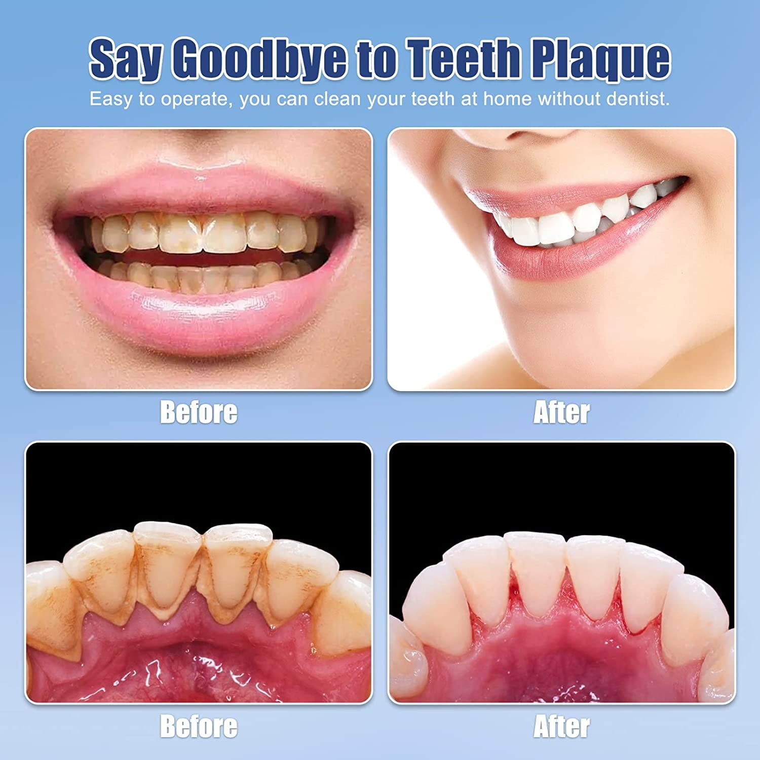 Plaque Remover for Teeth, Ultrasonic Tooth Cleaner Electric Dental Calculus Remover Teeth Cleaning Kit with LED 5 Adjustable Modes 3 Replaceable Clean Heads for Remove Teeth Stain Plaque Calculus