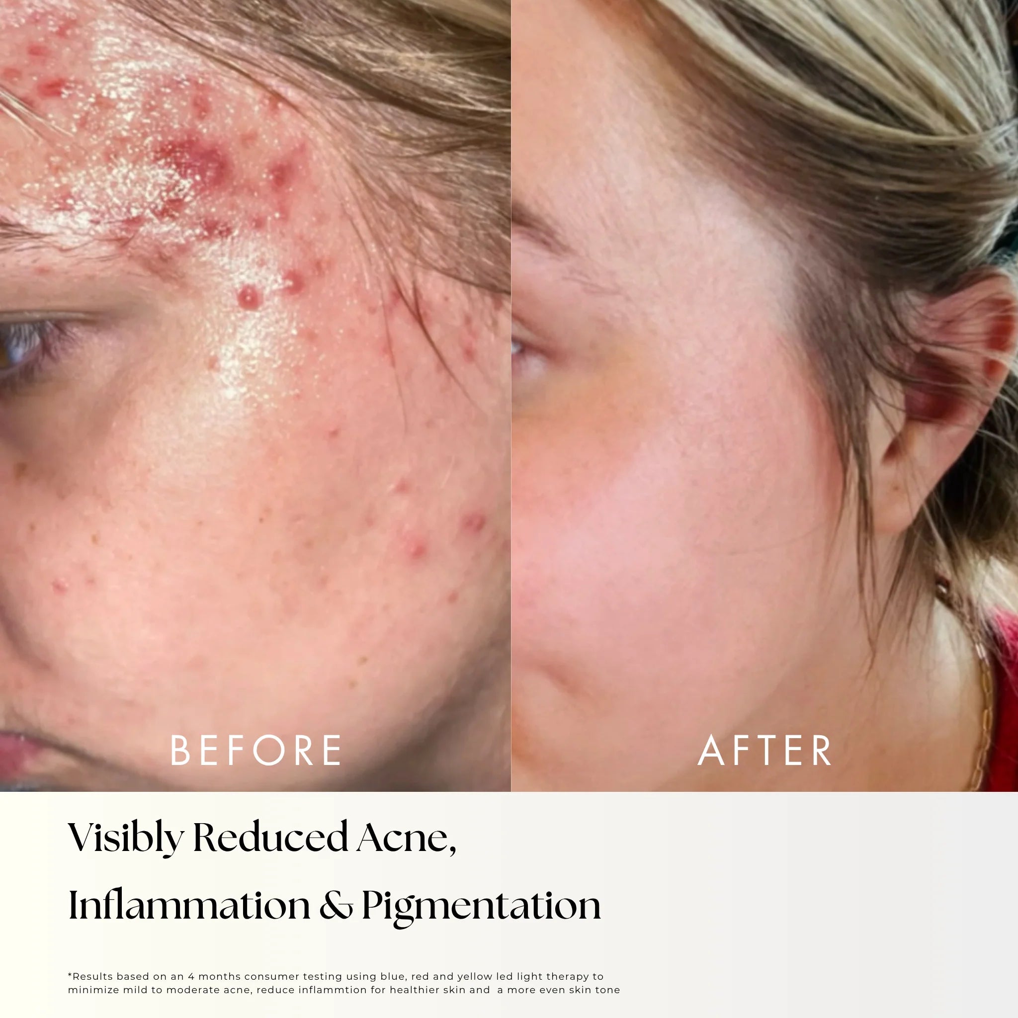 Nora - LED Light Therapy Mask