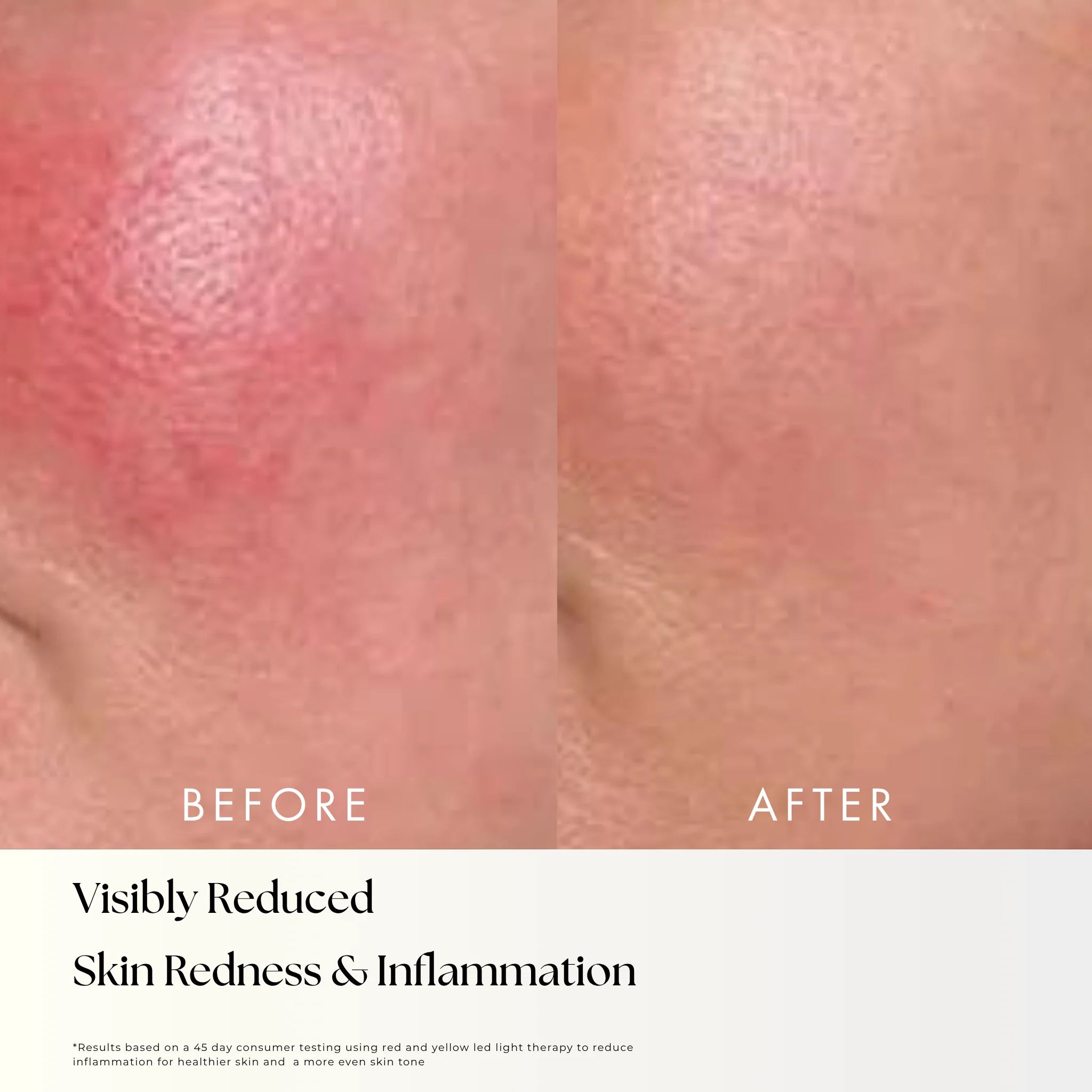 Nora - LED Light Therapy Mask